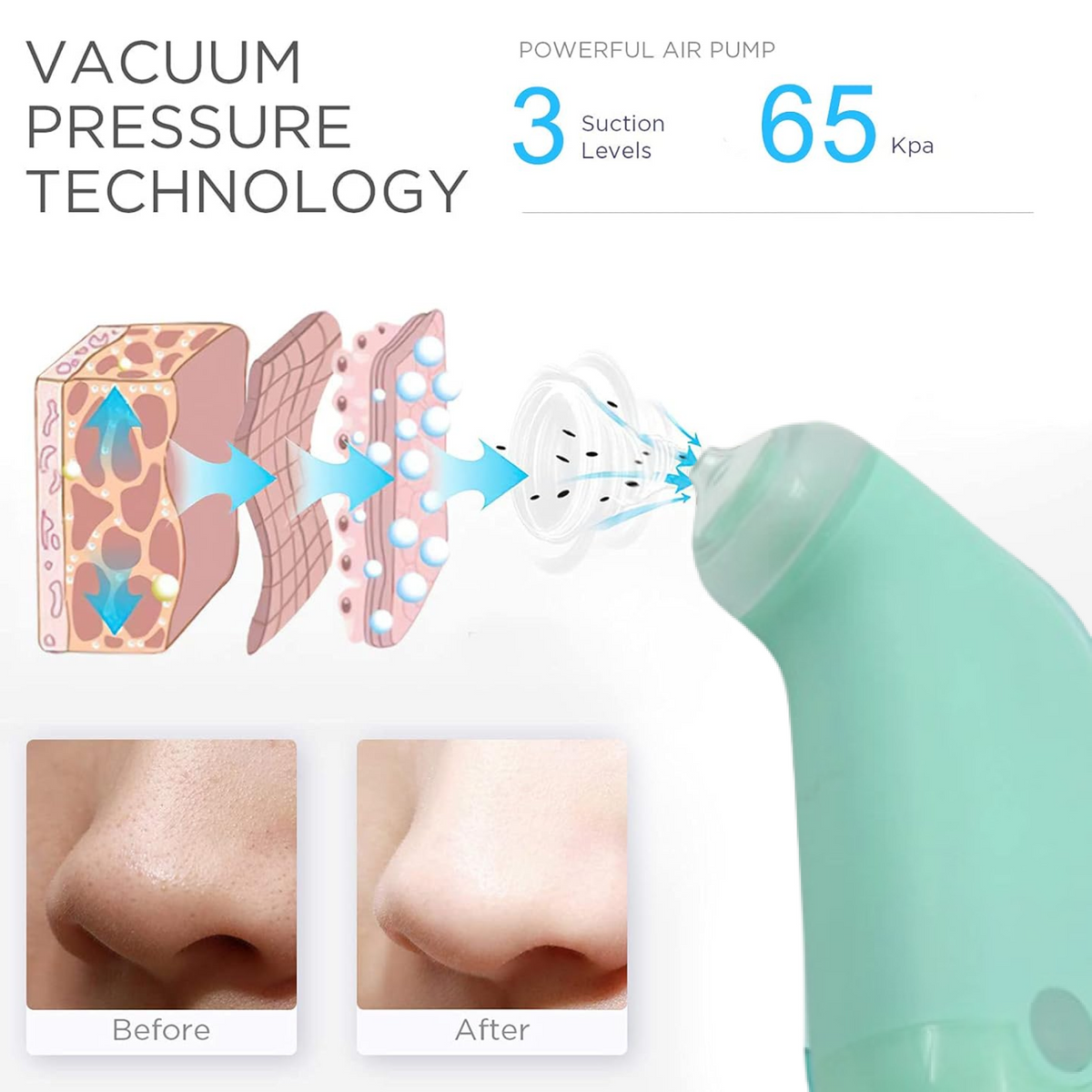 Vacuum Blackhead Remover Machine – Mini Handheld Facial Pore Cleaner & Lifting Massage Device for Deep Skin Care, Oil Control & Smooth Skin (1 Pc)