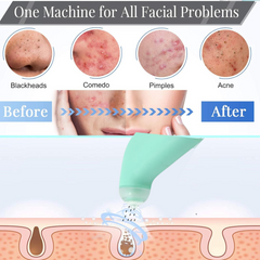 Vacuum Blackhead Remover Machine – Mini Handheld Facial Pore Cleaner & Lifting Massage Device for Deep Skin Care, Oil Control & Smooth Skin (1 Pc)